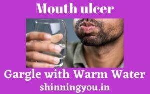 Mouth Ulcer- Gargle with warm water