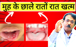Mouth ulcer Instant Relief
